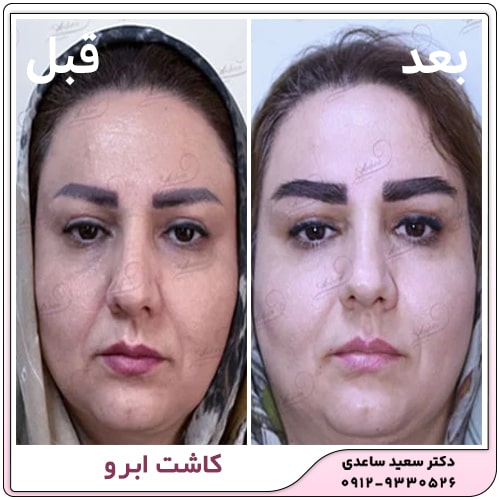 کاشت ابرو