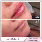 ژل لب