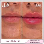 ژل لب