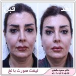 لیفت صورت با نخ
