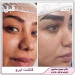 کاشت ابرو