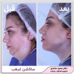 ساکشن غبغب