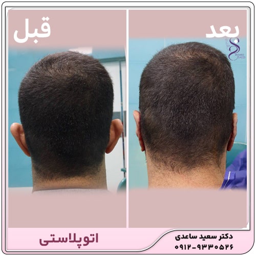 نمونه کار اتوپلاستی
