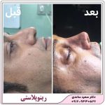 رینوپلاستی یا عمل زیبایی بینی