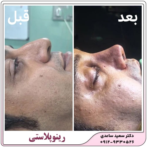 نمونه کار رینوپلاستی