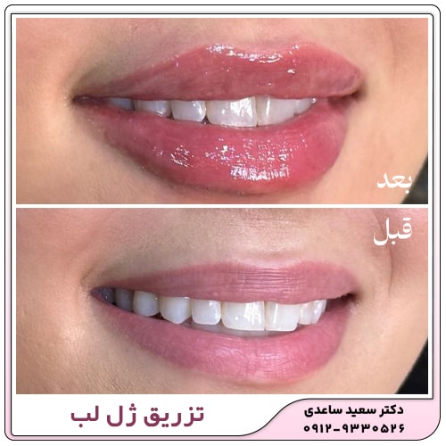نمونه کار تزریق ژل لب