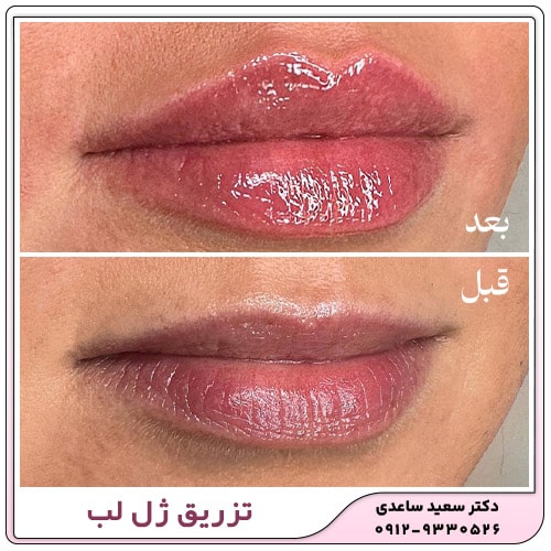 نمونه کار تزریق ژل لب