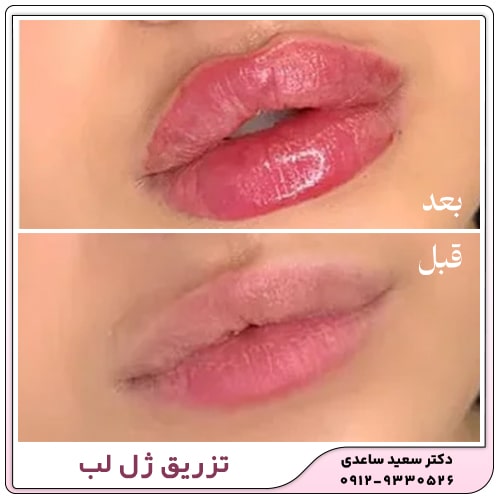 نمونه کار تزریق ژل لب