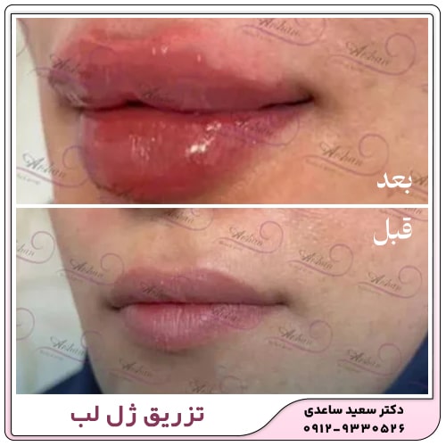 نمونه کار تزریق ژل لب