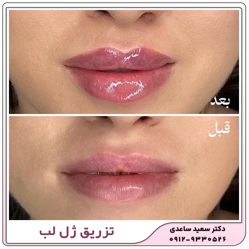 نمونه کار تزریق ژل لب
