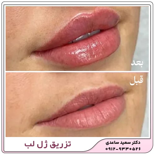 نمونه کار تزریق ژل لب