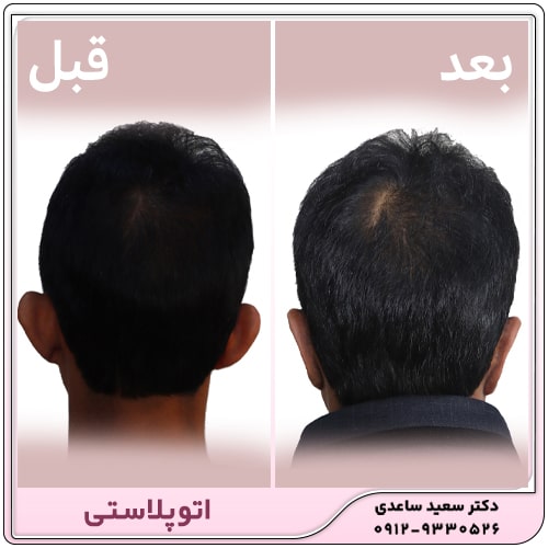 اتوپلاستی