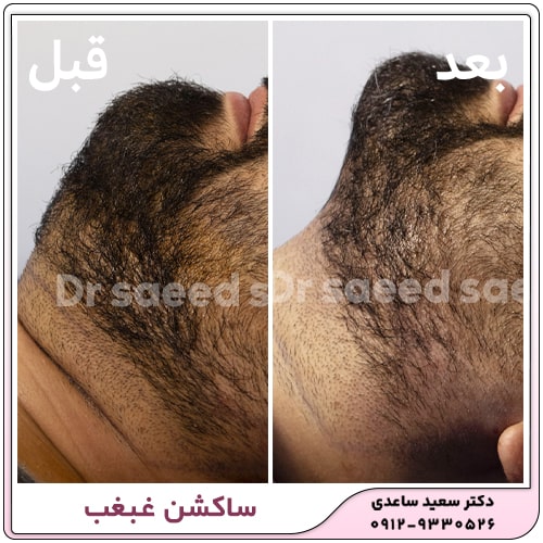 نمونه کار ساکشن غبغب