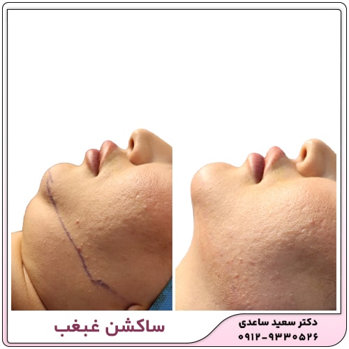 نمونه کار ساکشن غبغب