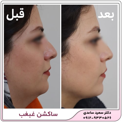 نمونه کار ساکشن غبغب