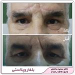 لیفت ابرو و بلفاروپلاستی