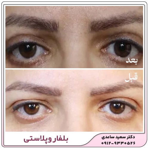 نمونه کار بلفاروپلاستی