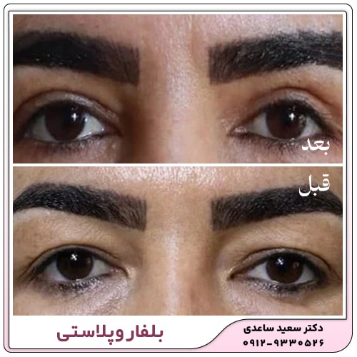 نمونه کار بلفاروپلاستی