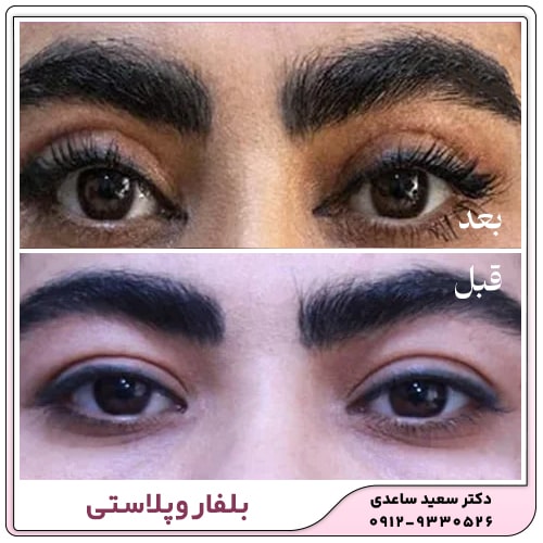 نمونه کار بلفاروپلاستی