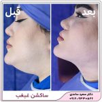 ساکشن غبغب