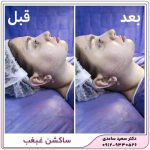 ساکشن غبغب