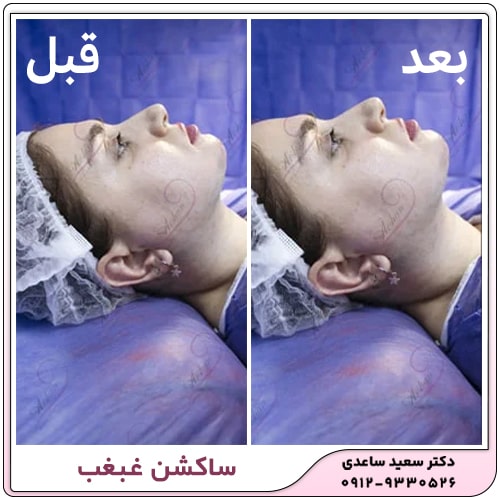 نمونه کار ساکشن غبغب