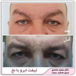 لیفت ابرو با نخ