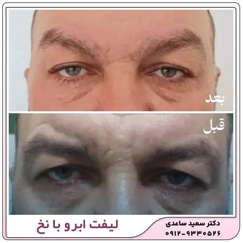 نمونه کار لیفت ابرو با نخ
