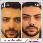 لیفت ابرو با نخ