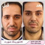 لیفت ابرو با نخ