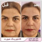 لیفت ابرو با نخ