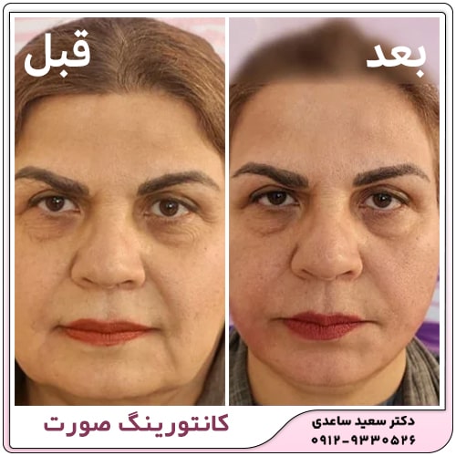 نمونه کار لیفت ابرو با نخ