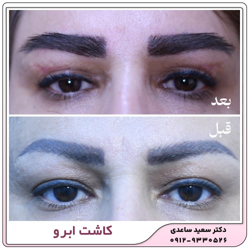 نمونه کار کاشت ابرو
