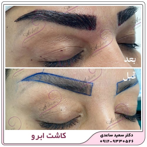 نمونه کار کاشت ابرو