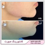زاویه سازی فک و صورت