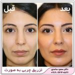 تزریق چربی به صورت