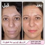 تزریق چربی به صورت