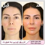 تزریق چربی به صورت