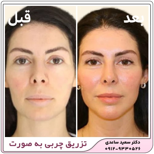 آیا بعد از تزریق چربی صورت کبود میشود+تزریق چربی به صورت چقدر ماندگاری دارد
