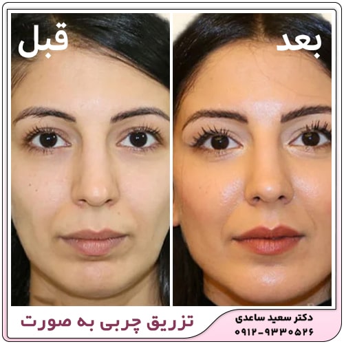 عکس قبل و بعد لاغری صورت+عکس تزریق چربی به صورت بعد از یک ماه