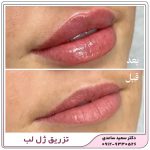تزریق ژل لب