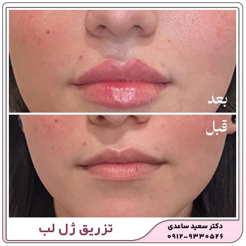 نمونه کار تزریق ژل لب