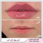 تزریق ژل لب