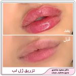 تزریق ژل لب