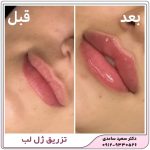 تزریق ژل لب