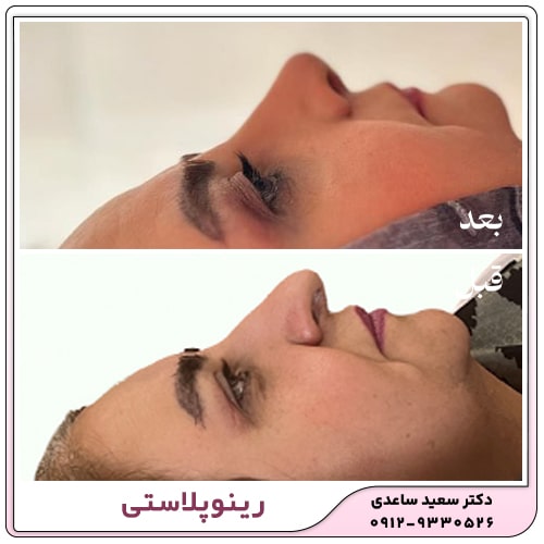 نمونه کار رینوپلاستی