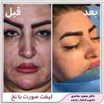 لیفت صورت با نخ