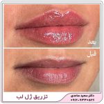 فیلر لب