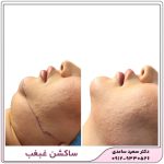 ساکشن غبغب