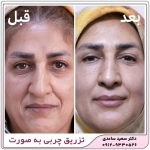تزریق چربی به صورت